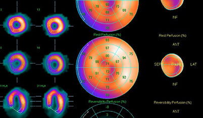 Scintigraphie myocardique